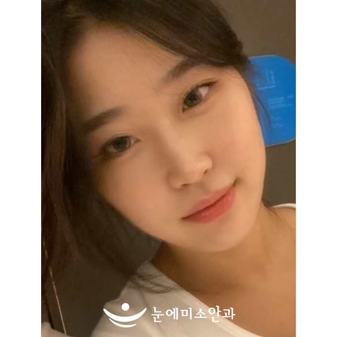 가까이 있는 것, 멀리 있는 것 다 잘 보이고 씻을 때 거울이 보여서 너무 좋아요. 안경 썼을 때보다 인상이 좋고, 원래도 빛 번짐이 심했는데 수술 후 조금 더 적어져서 좋았어요