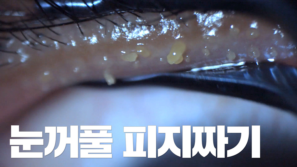눈꺼풀 피지 짜기  마이봄샘 짜기  안구건조증 치료